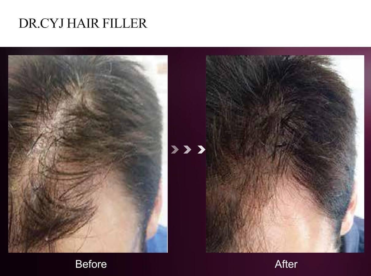Haarfiller-02